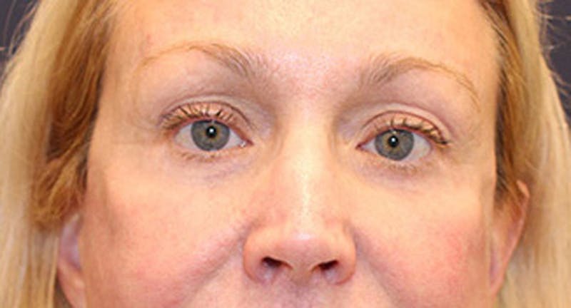 Eyelid Surgery Before & After Gallery - Patient 174146453 - Image 2