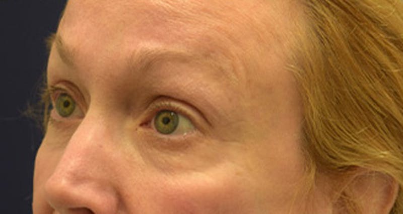 Eyelid Surgery Before & After Gallery - Patient 174146453 - Image 3