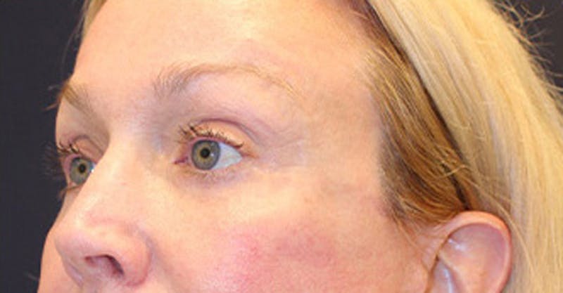 Eyelid Surgery Before & After Gallery - Patient 174146453 - Image 4