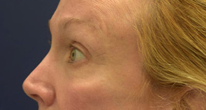 Eyelid Surgery Before & After Gallery - Patient 174146453 - Image 5
