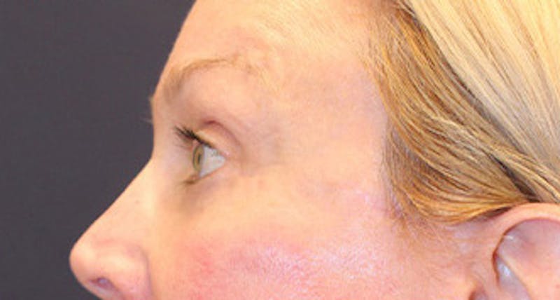 Eyelid Surgery Before & After Gallery - Patient 174146453 - Image 6