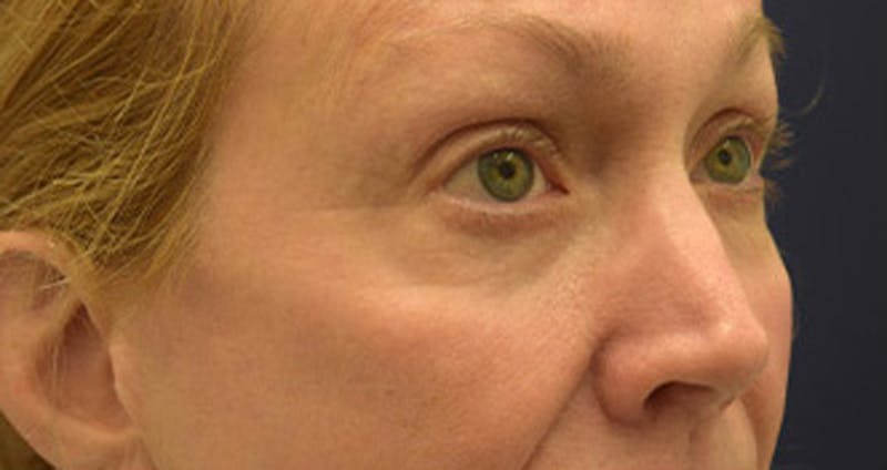 Eyelid Surgery Before & After Gallery - Patient 174146453 - Image 7