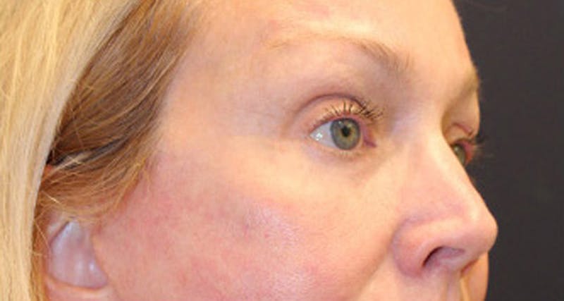 Eyelid Surgery Before & After Gallery - Patient 174146453 - Image 8