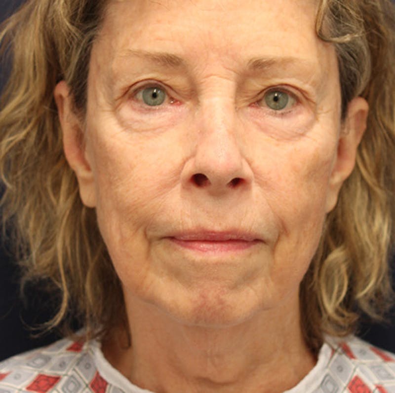 Facelift Before & After Gallery - Patient 174146421 - Image 1