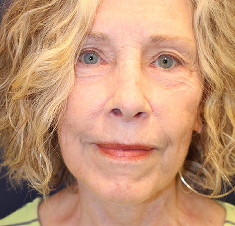 Facelift Before & After Gallery - Patient 174146421 - Image 2