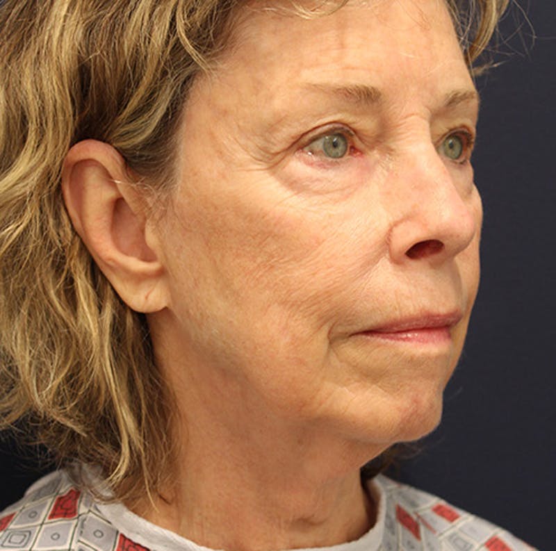 Facelift Before & After Gallery - Patient 174146421 - Image 3