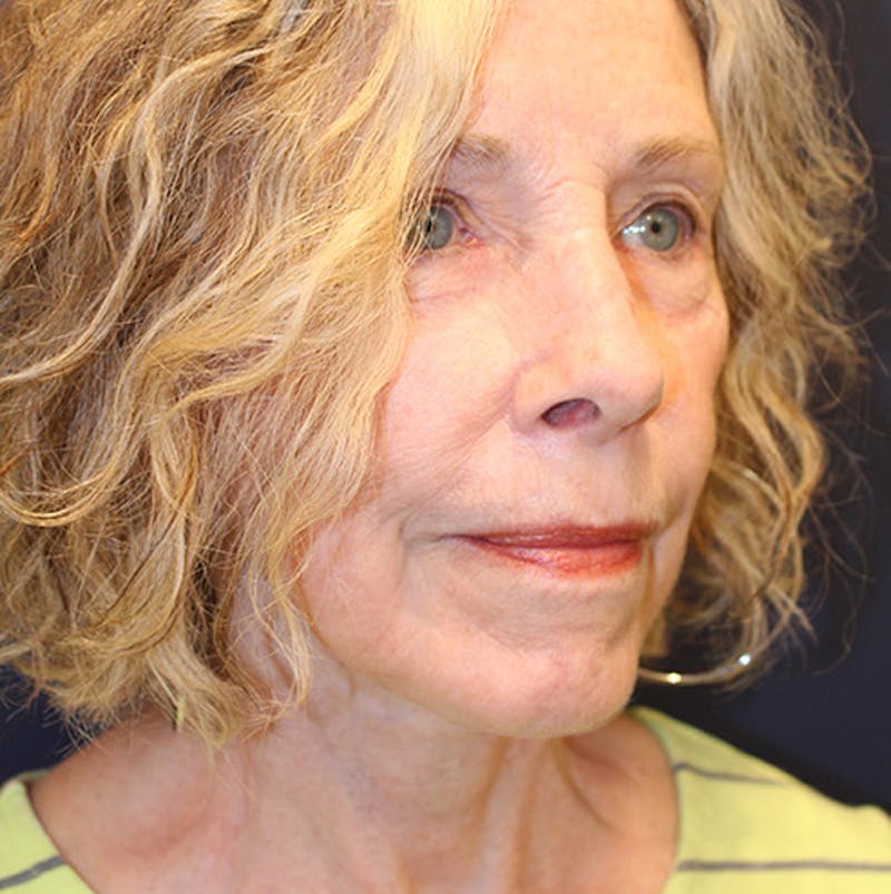 Facelift Before & After Gallery - Patient 174146421 - Image 4