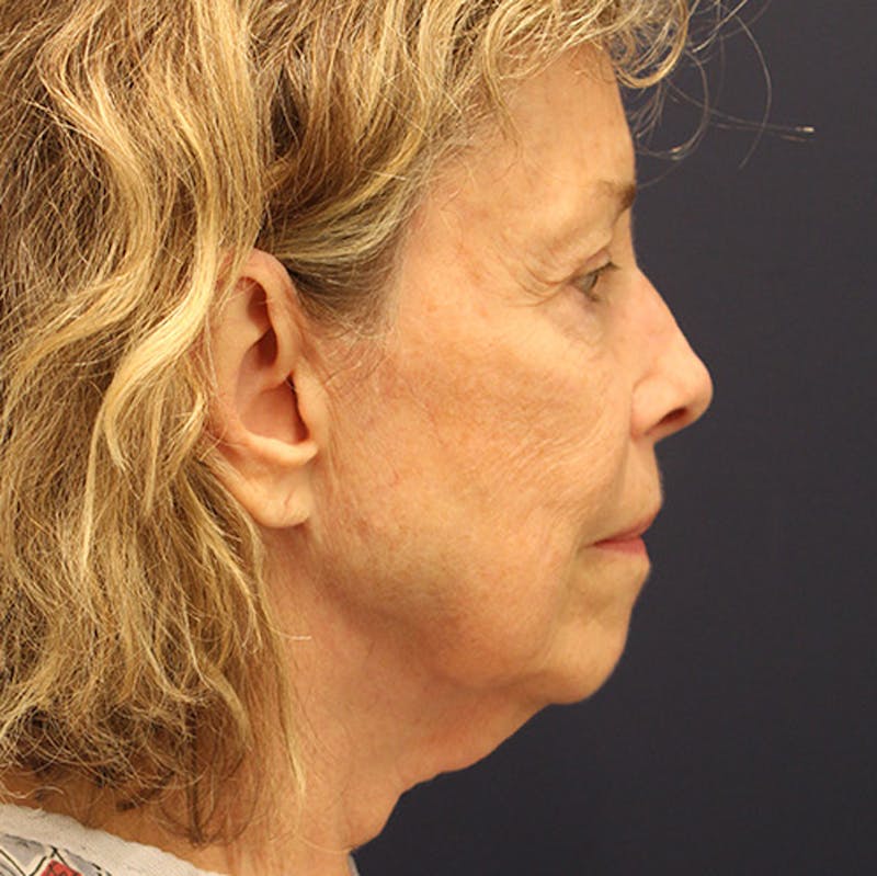 Facelift Before & After Gallery - Patient 174146421 - Image 5