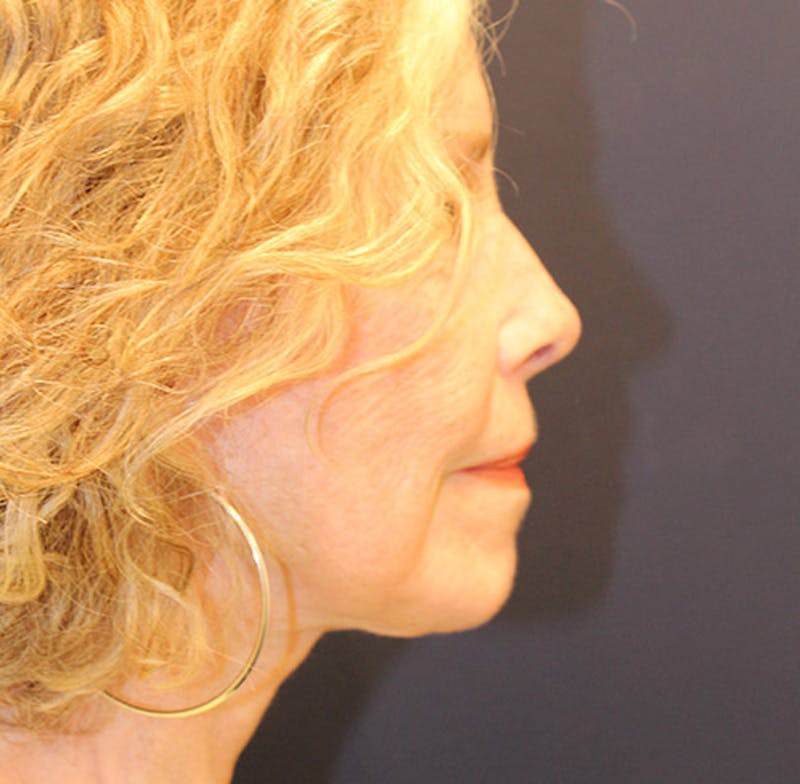 Facelift Before & After Gallery - Patient 174146421 - Image 6
