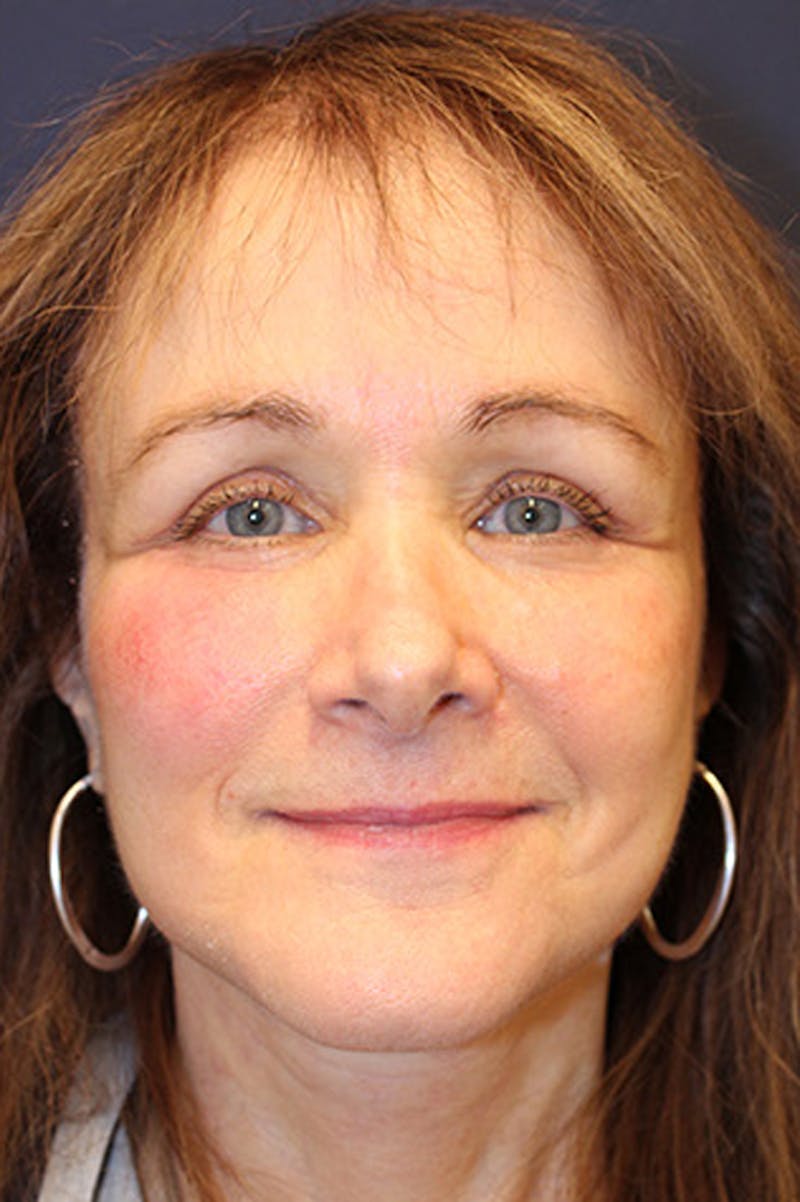 Necklift Before & After Gallery - Patient 349241 - Image 2