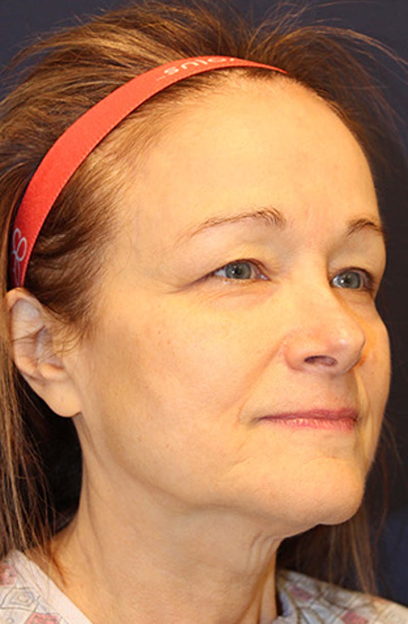Facelift Before & After Gallery - Patient 174146423 - Image 3