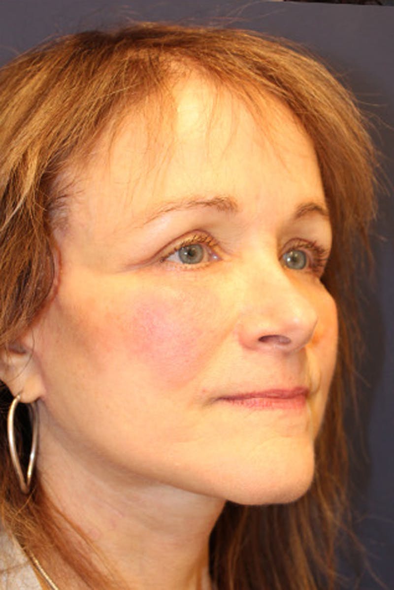 Facelift Before & After Gallery - Patient 174146423 - Image 4