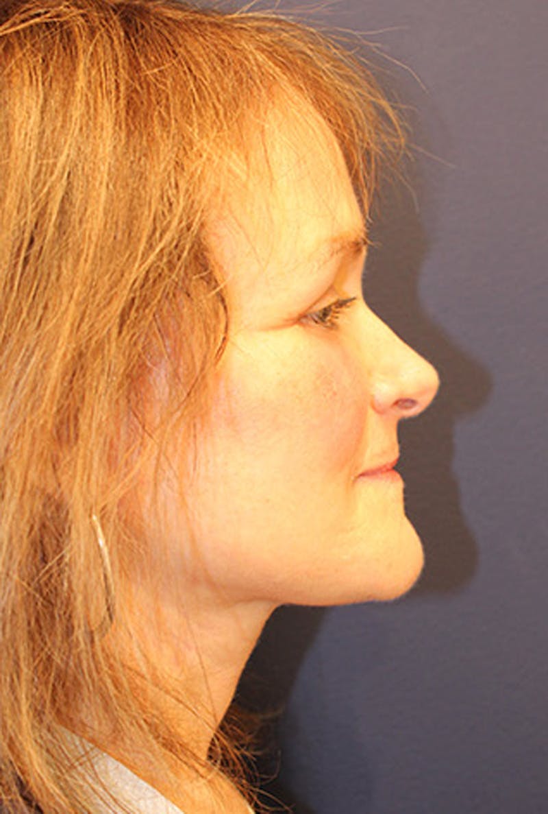 Facelift Before & After Gallery - Patient 174146423 - Image 6