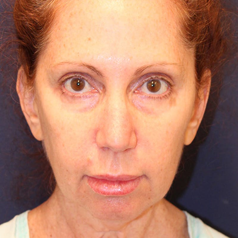 Facelift Before & After Gallery - Patient 174146425 - Image 1