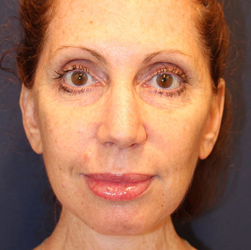 Facelift Before & After Gallery - Patient 174146425 - Image 2