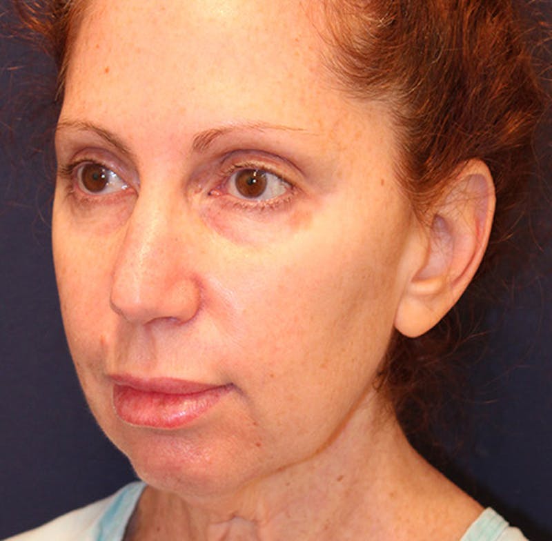 Facelift Before & After Gallery - Patient 174146425 - Image 3