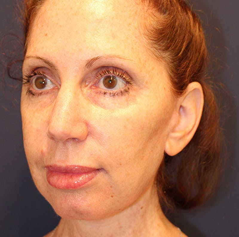 Facelift Before & After Gallery - Patient 174146425 - Image 4