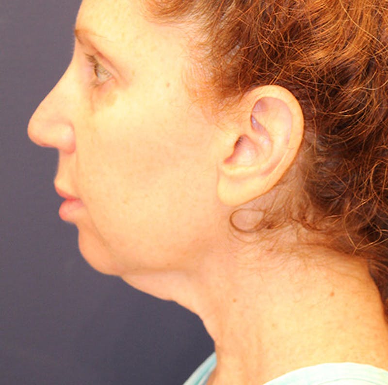 Facelift Before & After Gallery - Patient 174146425 - Image 5