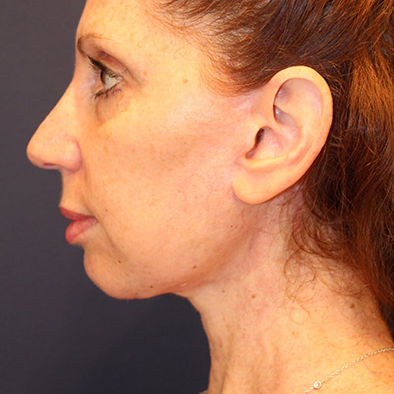 Facelift Before & After Gallery - Patient 174146425 - Image 6