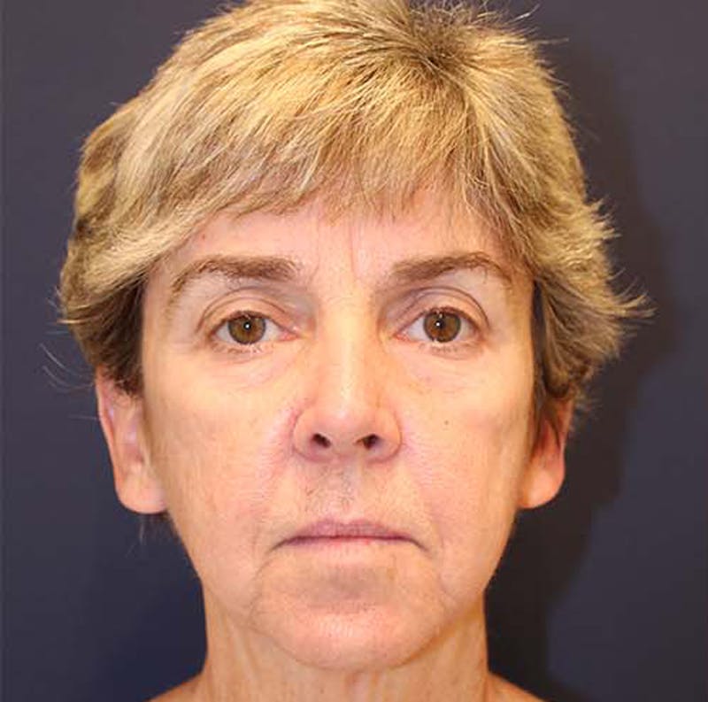 Facelift Before & After Gallery - Patient 174146428 - Image 1