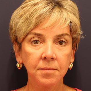 Facelift Before & After Gallery - Patient 174146428 - Image 2