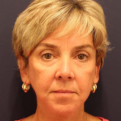 Facelift Before & After Gallery - Patient 174146428 - Image 2