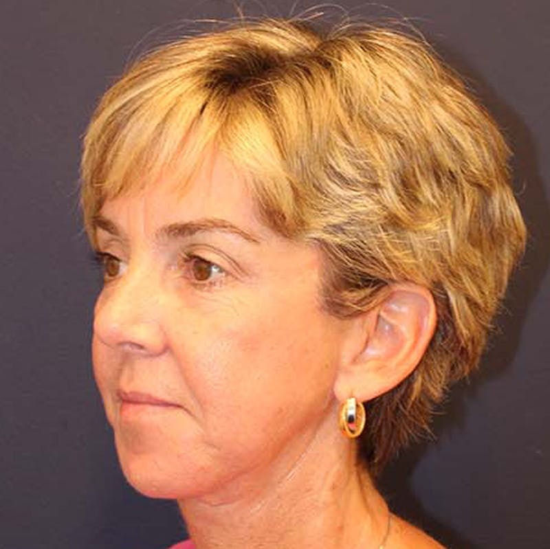 Facelift Before & After Gallery - Patient 174146428 - Image 4
