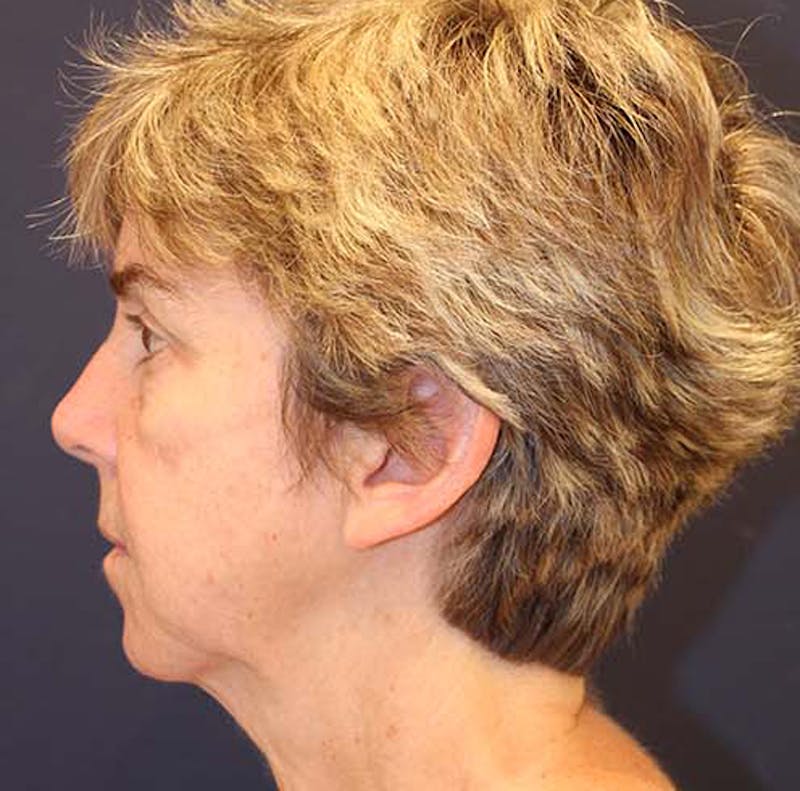 Facelift Before & After Gallery - Patient 174146428 - Image 5