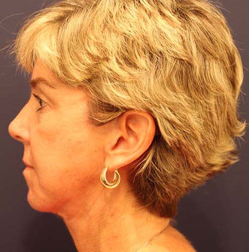 Facelift Before & After Gallery - Patient 174146428 - Image 6