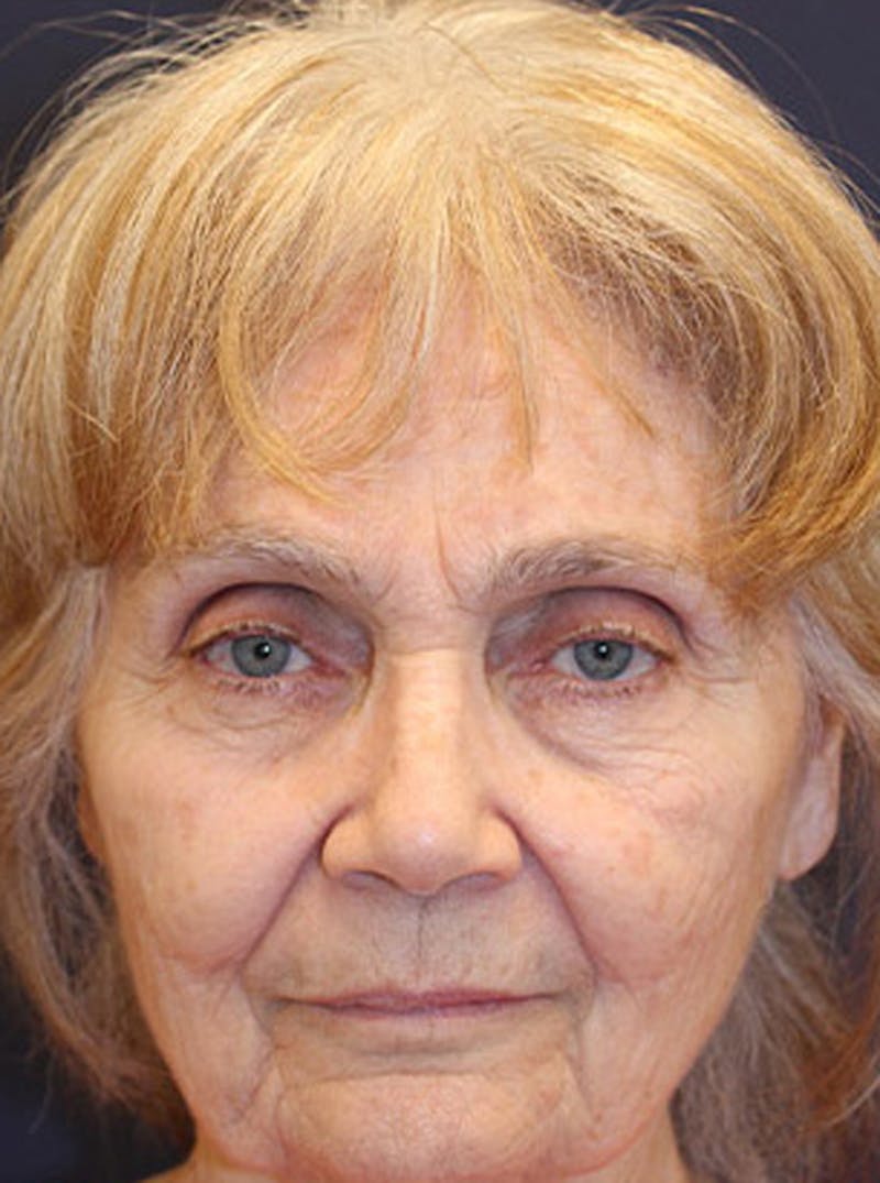 Facelift Before & After Gallery - Patient 174146432 - Image 1