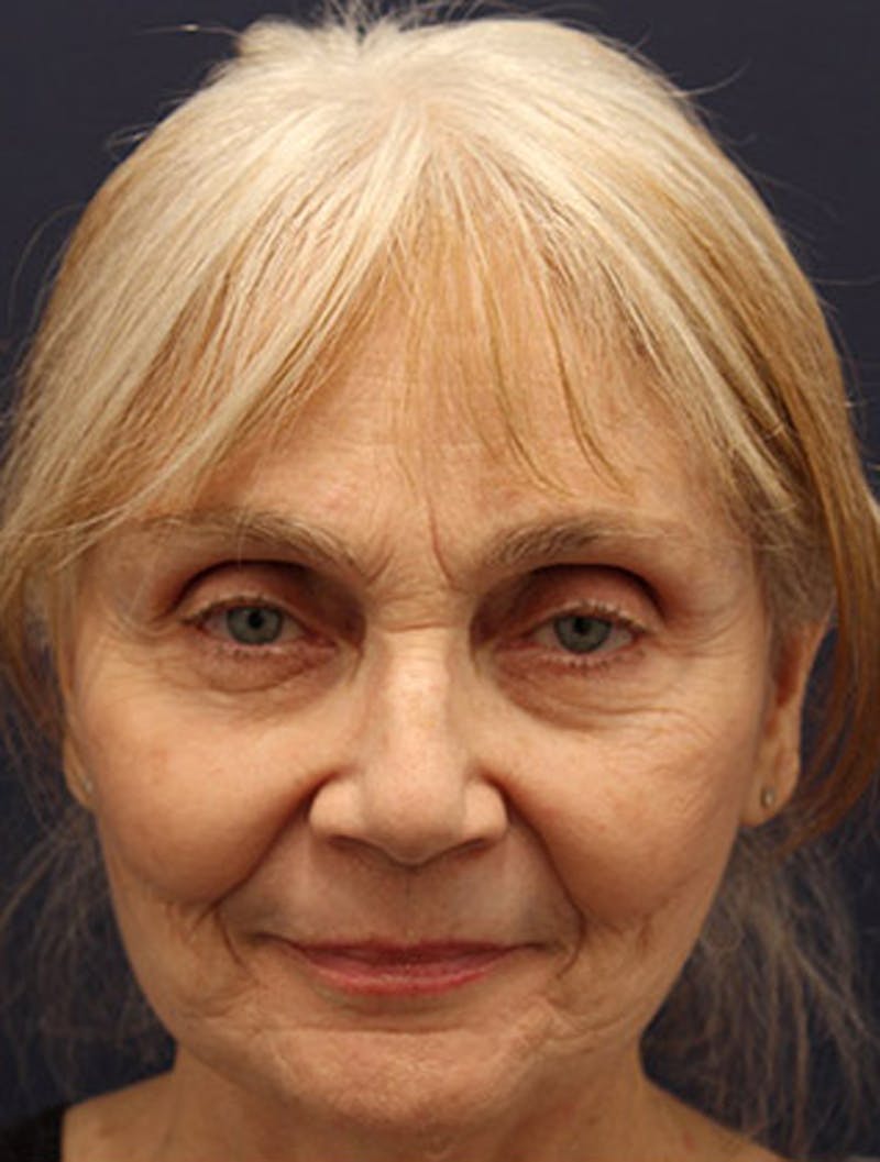 Facelift Before & After Gallery - Patient 174146432 - Image 2