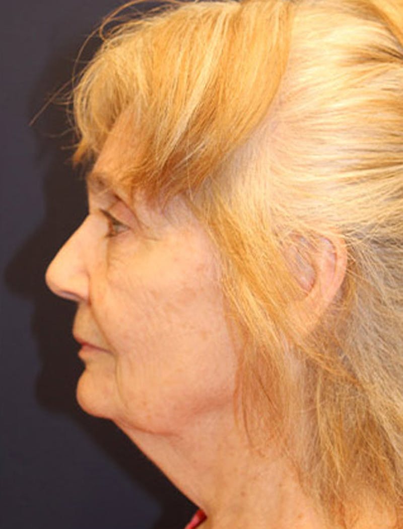 Facelift Before & After Gallery - Patient 174146432 - Image 5