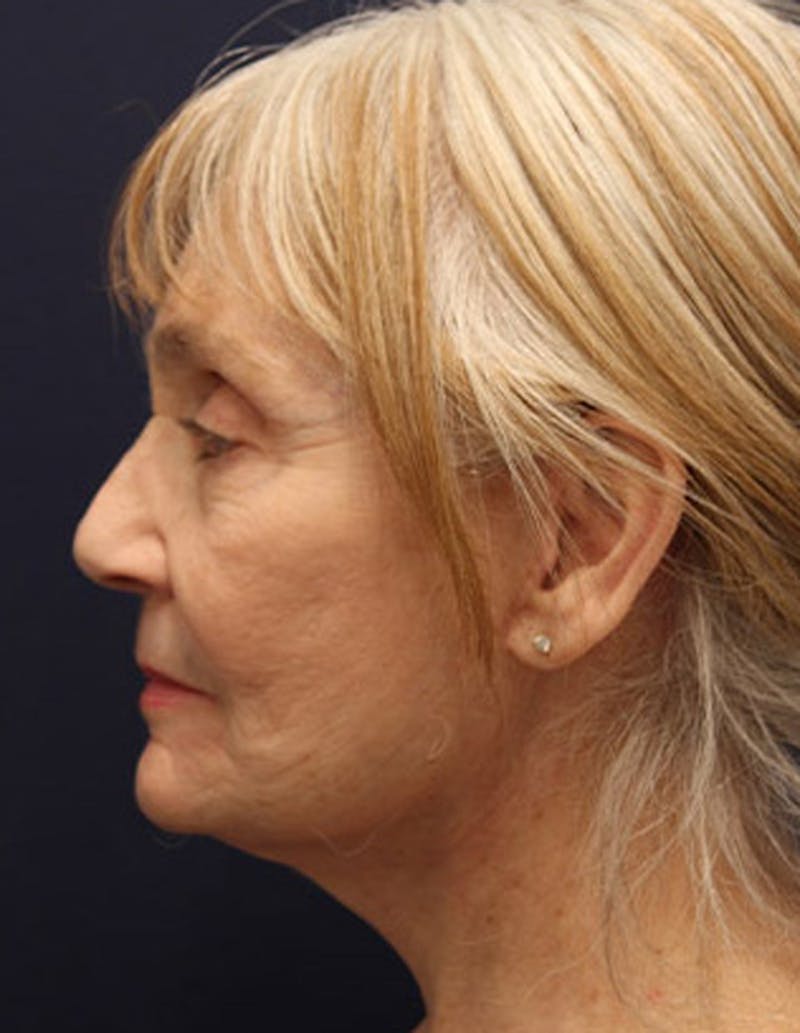 Facelift Before & After Gallery - Patient 174146432 - Image 6