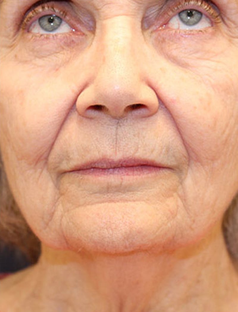 Facelift Before & After Gallery - Patient 174146432 - Image 7