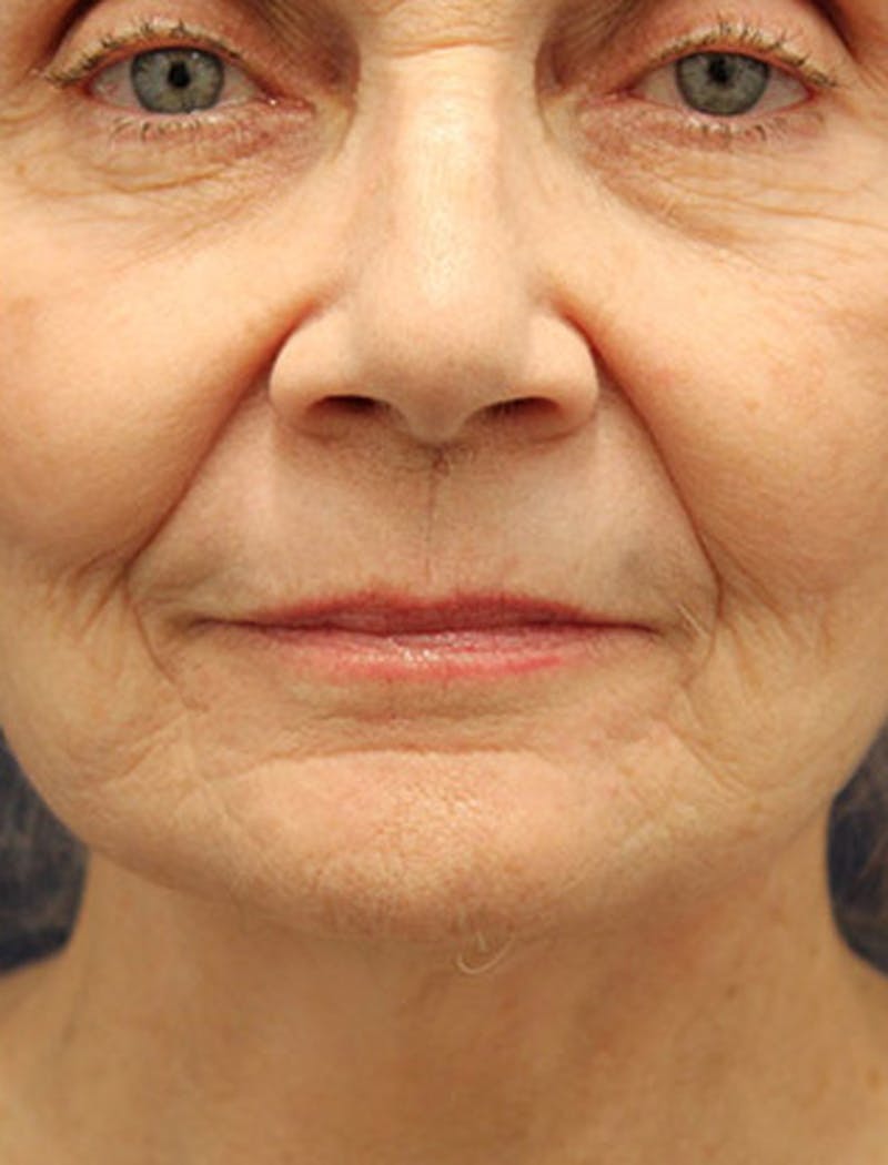 Facelift Before & After Gallery - Patient 174146432 - Image 8