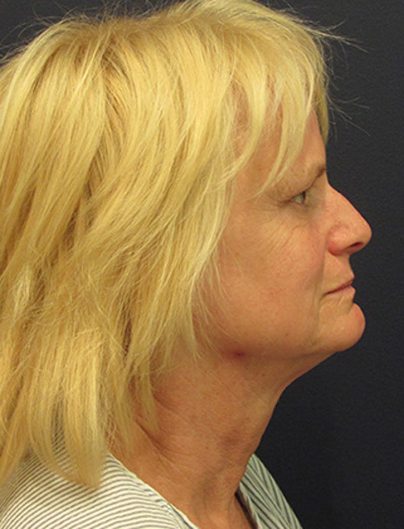 Facelift Before & After Gallery - Patient 174146435 - Image 5