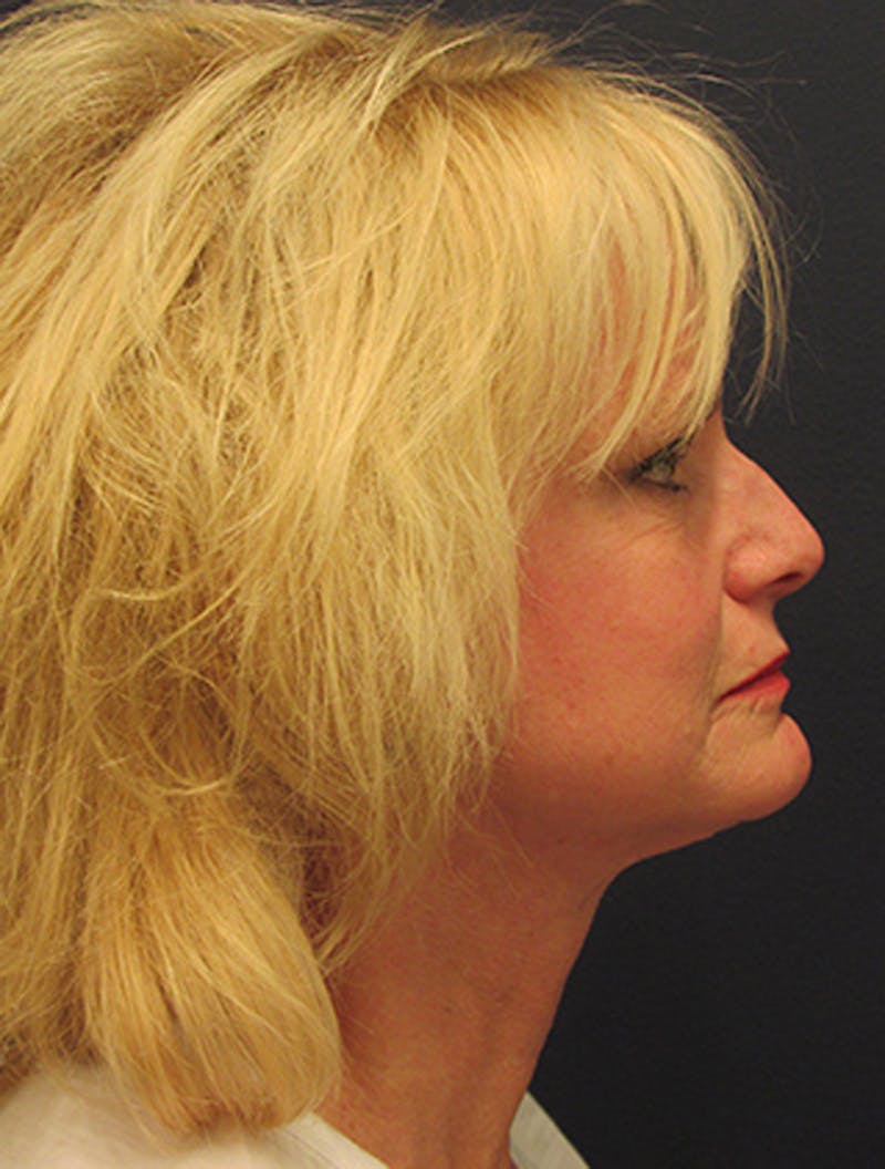 Facelift Before & After Gallery - Patient 174146435 - Image 6