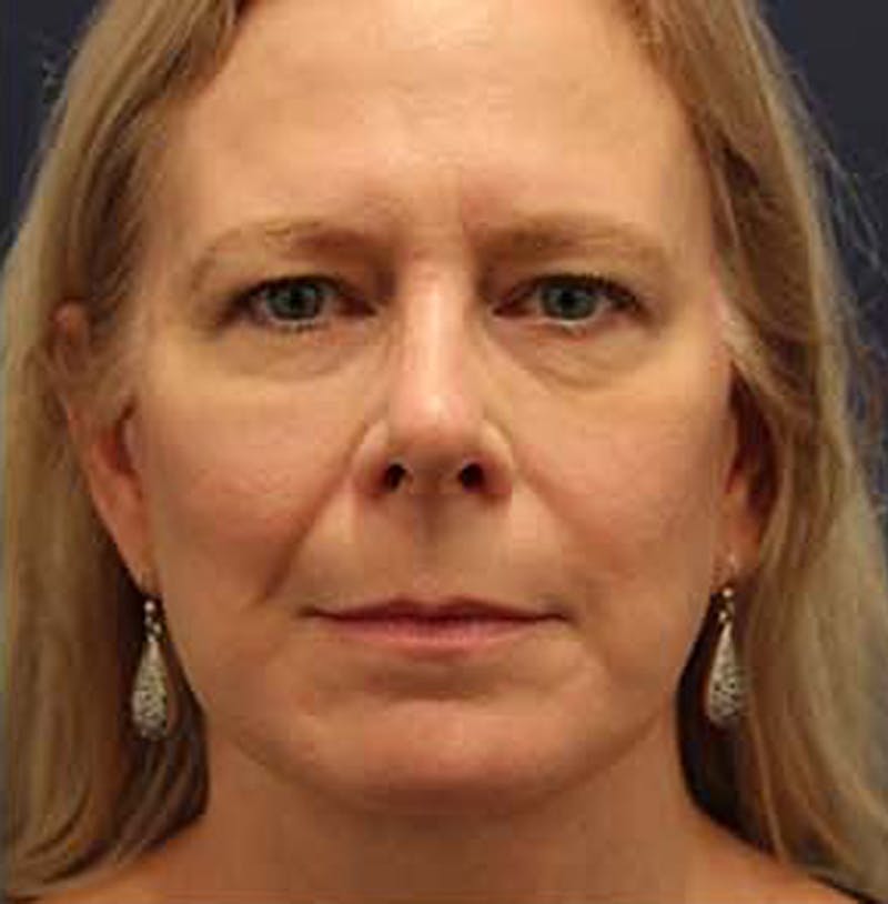 Facelift Before & After Gallery - Patient 174146438 - Image 2