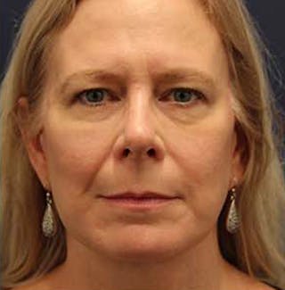 Necklift Before & After Gallery - Patient 164160 - Image 2