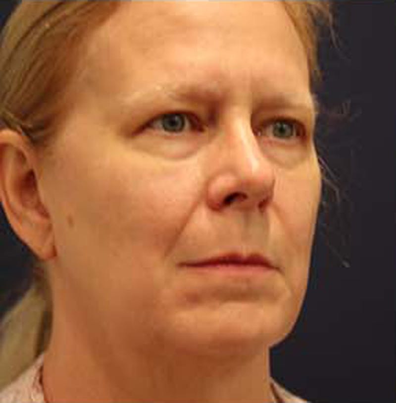Facelift Before & After Gallery - Patient 174146438 - Image 3