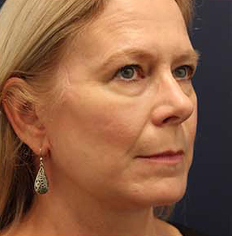 Facelift Before & After Gallery - Patient 174146438 - Image 4