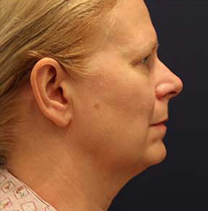 Facelift Before & After Gallery - Patient 174146438 - Image 5