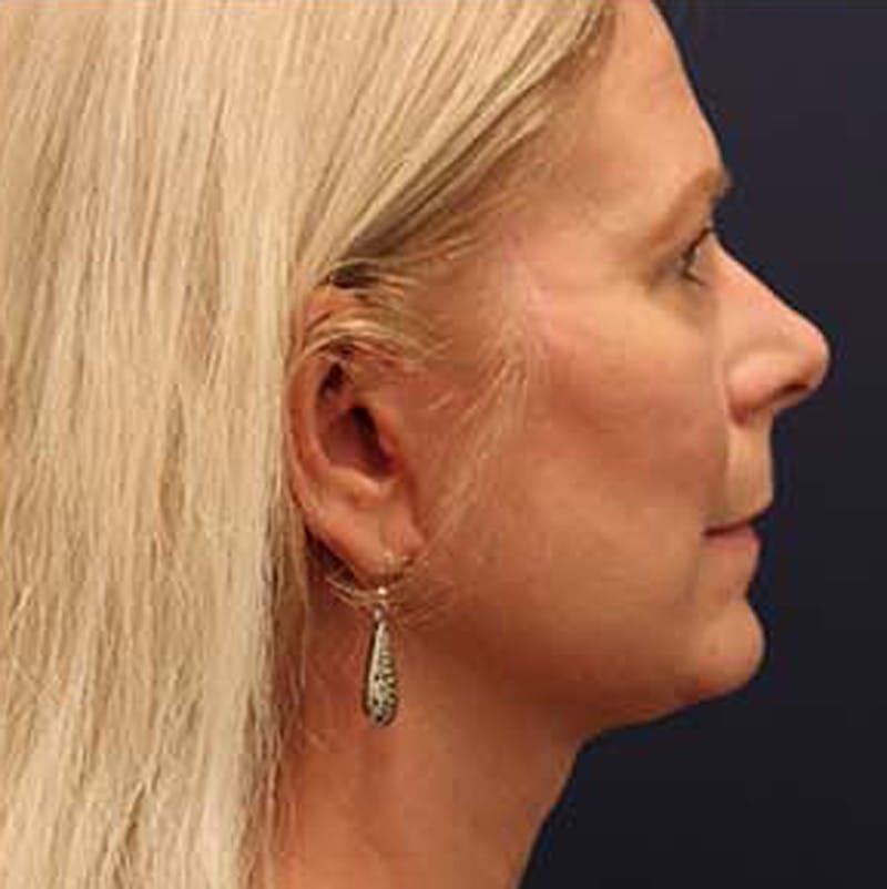 Necklift Before & After Gallery - Patient 164160 - Image 6