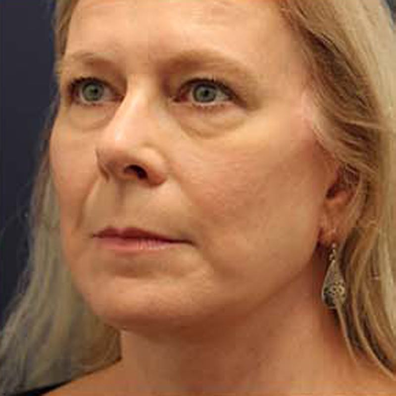 Facelift Before & After Gallery - Patient 174146438 - Image 8