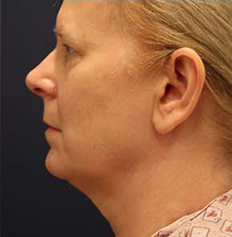 Necklift Before & After Gallery - Patient 164160 - Image 9