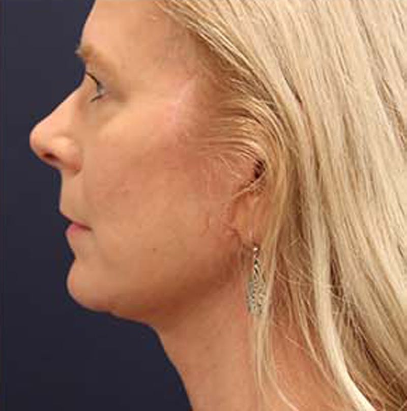 Necklift Before & After Gallery - Patient 164160 - Image 10