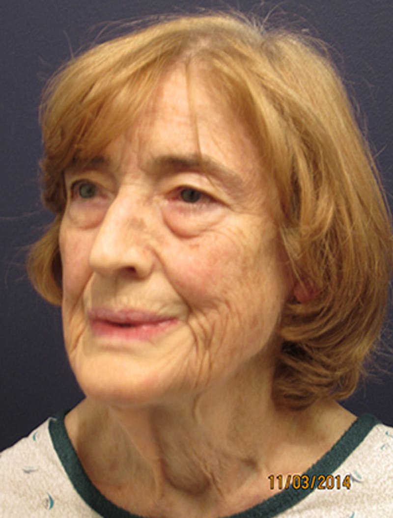 Facelift Before & After Gallery - Patient 174146442 - Image 3
