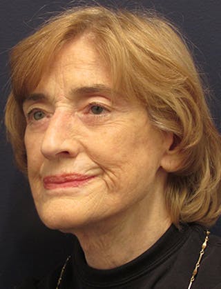 Facelift Before & After Gallery - Patient 174146442 - Image 4