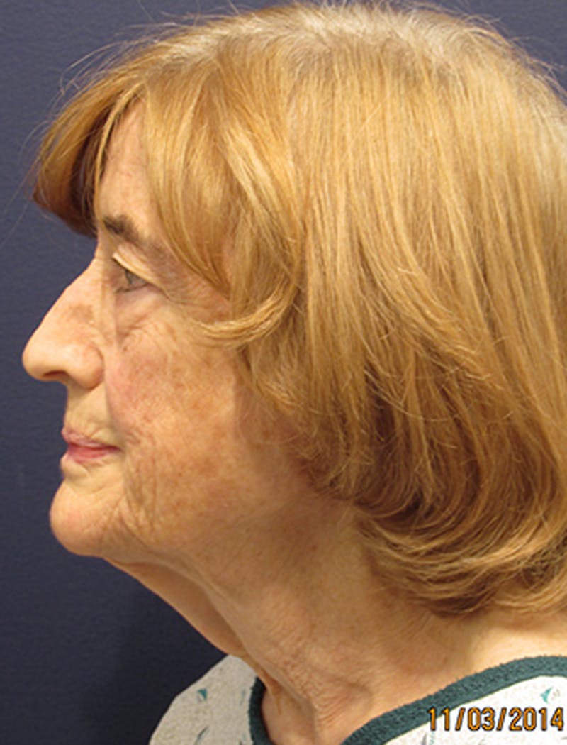 Facelift Before & After Gallery - Patient 174146442 - Image 5