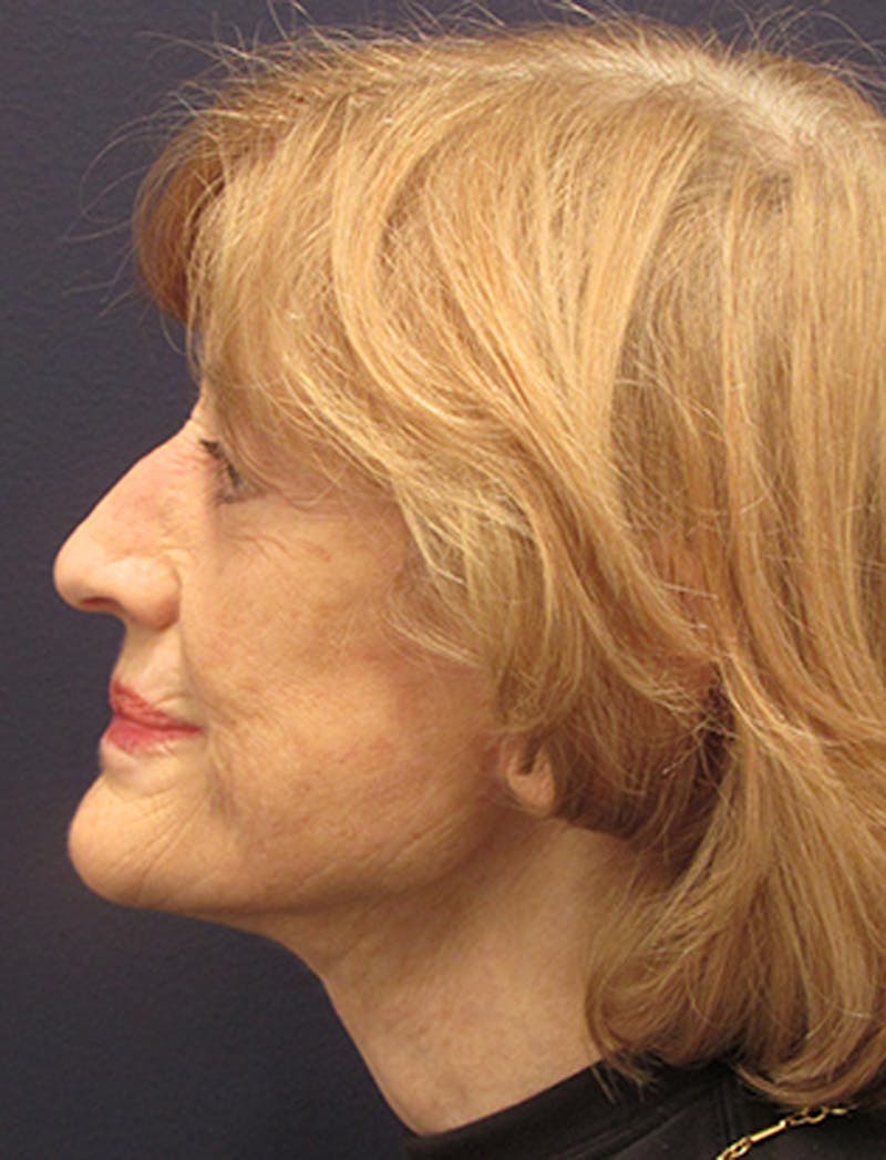 Facelift Before & After Gallery - Patient 174146442 - Image 6